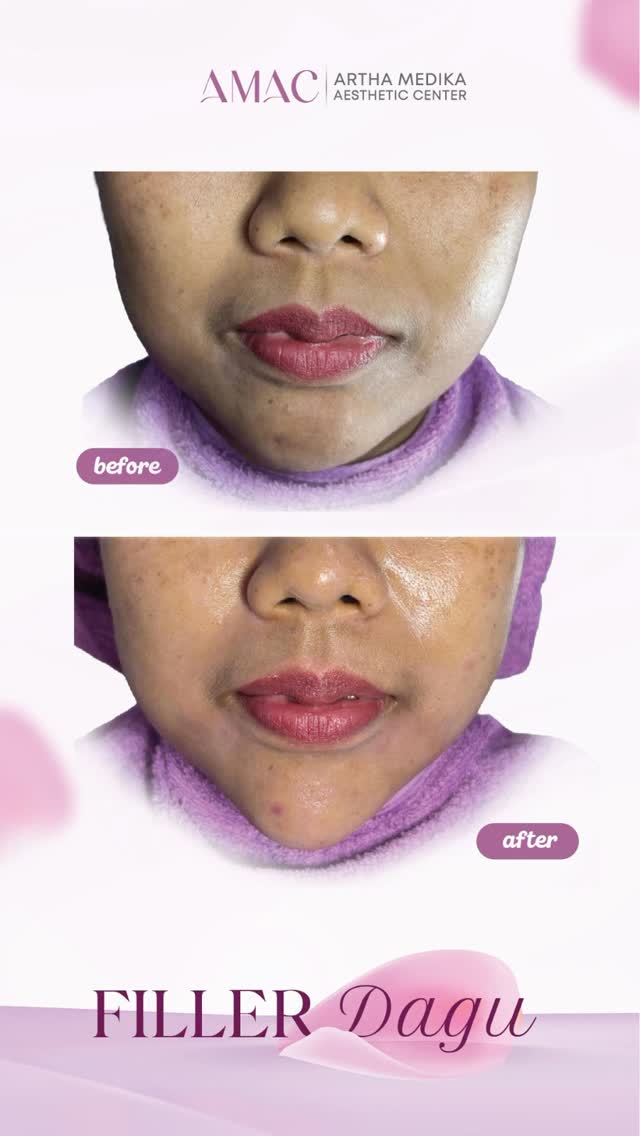 Cuplikan Before & After — Filler Dagu — konten AMAC